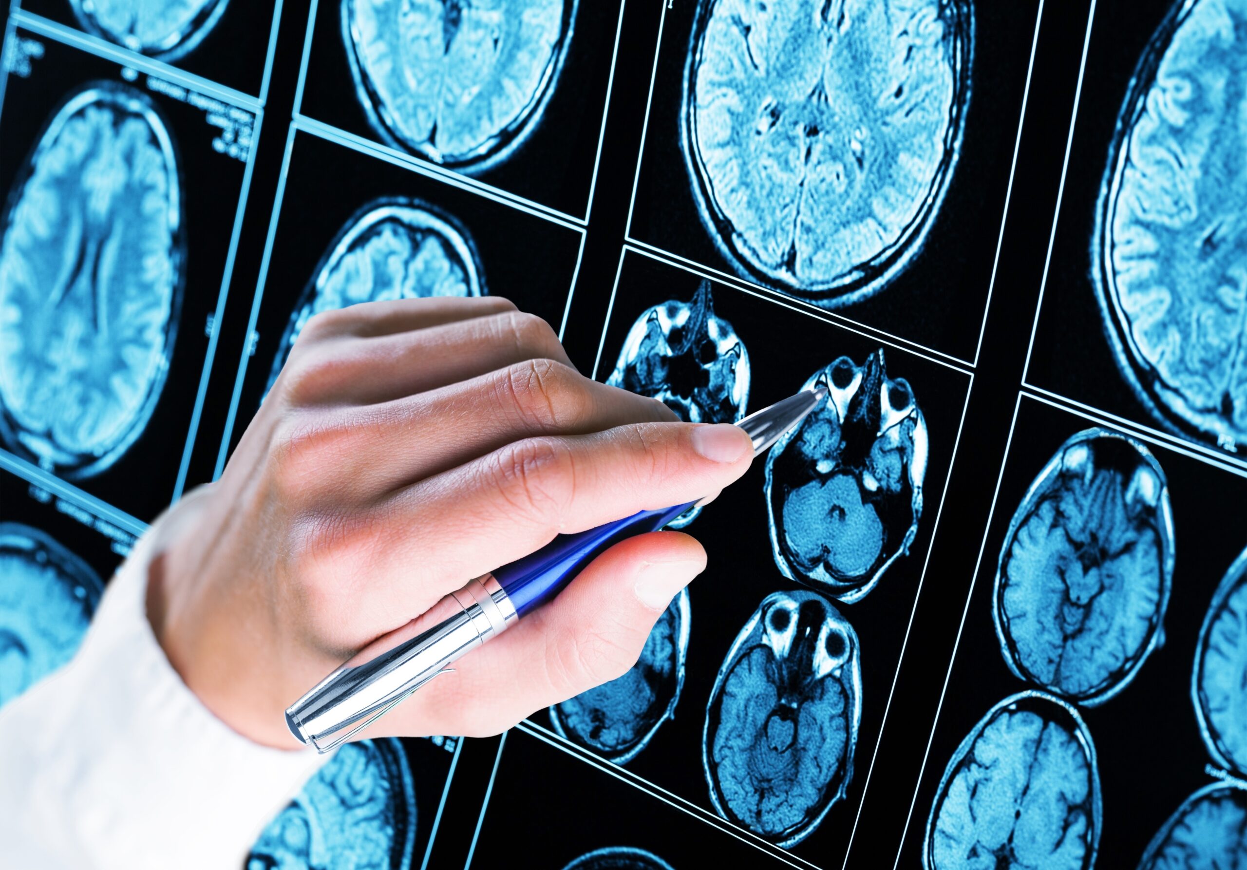 Choroby mózgu muszą być traktowane priorytetowo – apel ekspertów podczas posiedzenia Parlamentarnego Zespołu ds. Chorób Neurologicznych